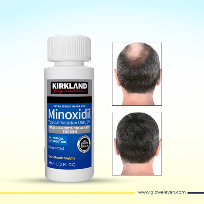 Kirkland 5% Minoxidil – Hair Loss & Hair Regrowth Treatment - Image 1